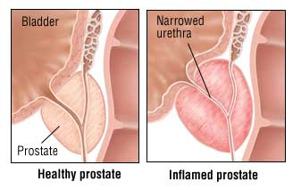 Inflamed prostate