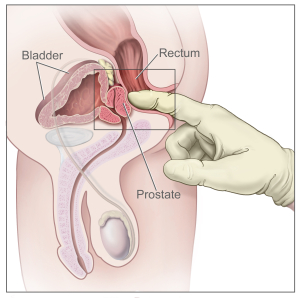 Digital rectal exam: side view of the male reproductive and urinary anatomy, including the prostate, rectum, and bladder.  Image from Wikipedia