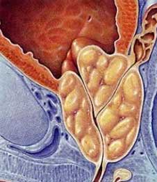 Benign Prostatic Hyperplasia (BPH)