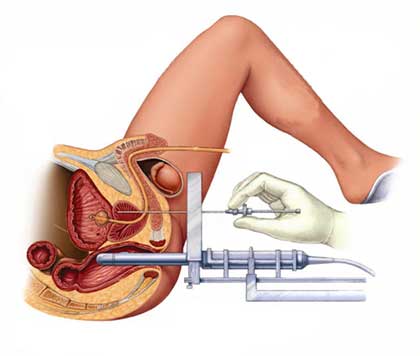 Brachytherapy