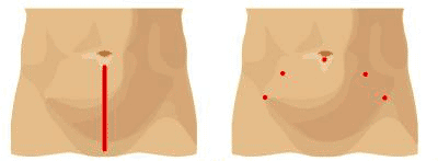 Comparing incisions