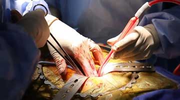 open surgery