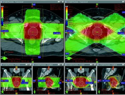 External Beam Radiotherapy 