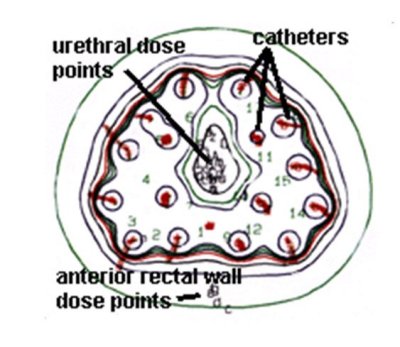 Radiation figure